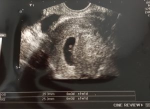 5週5日 胎嚢 胎芽 心拍を確認できました